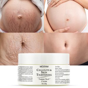 Obesity body line care cream tightens, nourishes, and lightens postpartum stretch marks repair cream