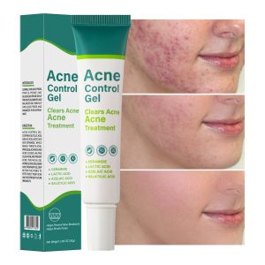 Salicylic acid azelaic acid gel reduces acne marks, shrinks pores, removes acne, closes mouth, ceramide lactic acid acne cream
