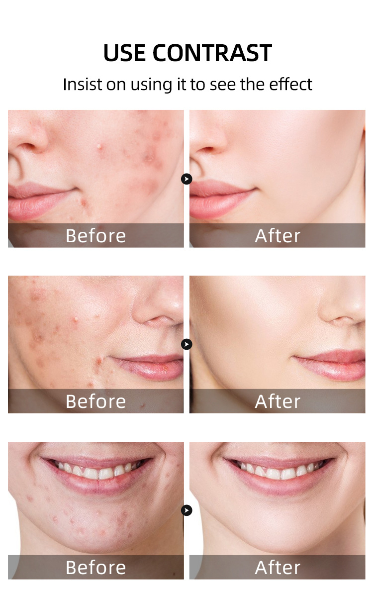 Salicylic acid acne cream fades acne scars, removes blackheads and closed comedones, shrinks pores; plant essence acne gel. - 图片 6