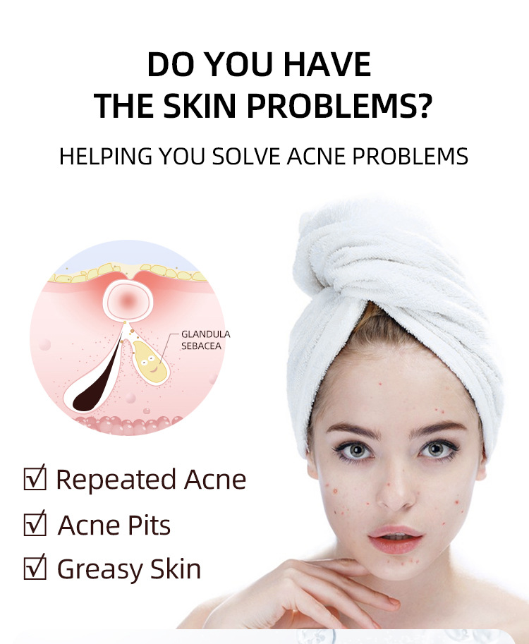 Salicylic acid acne cream fades acne scars, removes blackheads and closed comedones, shrinks pores; plant essence acne gel. - 图片 8